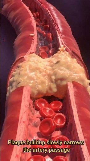 The Silent Artery Blockage That Can Stop Blood Flow