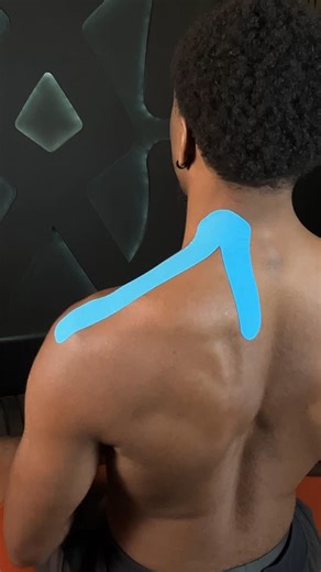 Spidertech Kinesiology Tape on Instagram: "Taping For Upper Trapezius Tension. Comment “Tape” Below To Unlock Our Masterclass. Tight, achy traps? You’re not alone. Upper trapezius tension is one of the most common complaints seen in clinical practice — often linked to stress, poor posture, or muscular overuse. This muscle runs from the base of the skull down to the shoulder, helping stabilize the neck and elevate the scapula. But when it’s overloaded — from long hours at a desk, constant lifting