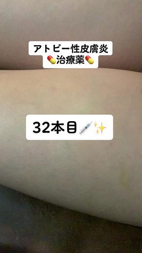使用してる人…いますか❓💉#アトピー性皮膚炎#アトピー#デュピクセント#自己注射#注射#痒み#皮膚#酷い#赤み