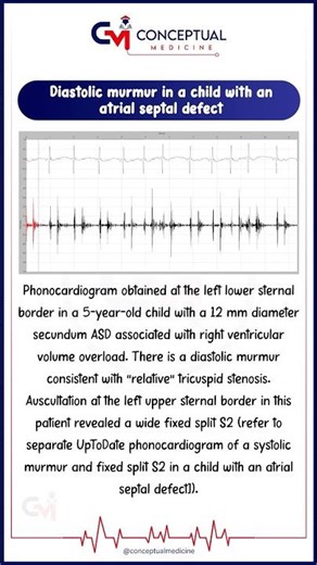 🫀 Diastolic Murmur in Atrial Septal Defect (ASD)