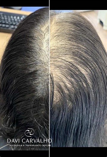 Tratamento Eficaz Para Alopecia Androgenética Feminina