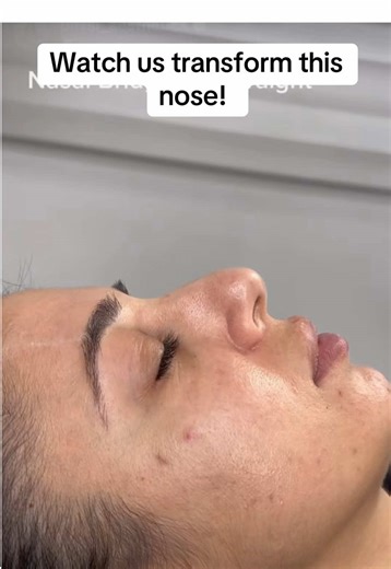 Nose Transformation with Fillers: Non-Surgical Results
