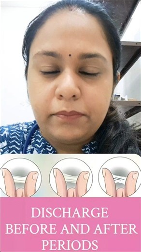 White discharge before and after Periods #periods #whitedischarge #leucorrhoea #menses #itching