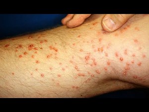 Home Remedies for Fire Ant Stings