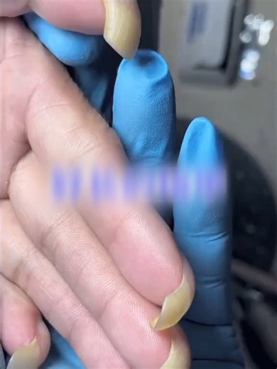 Trimming Curved Long Nails for Better Comfort