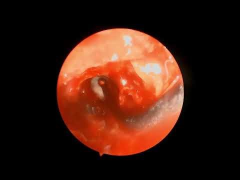Endoscopic Sinus Surgery | MMA + Anterior Ethmoidectomy + Frontal Sinus Pus Clearance