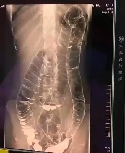 This is an X-ray image of a young woman who suffered from chronic constipation. One day, after experiencing continuous symptoms for over two weeks, she went for a medical check-up and received the X-ray results shown below...👇 | Chemteacherphil