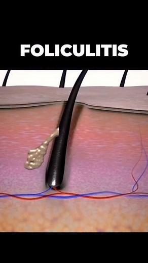 La foliculitis es una inflamación del folículo piloso, generalmente causada por bacterias, hongos y el exceso de grasa. Cuando ocurre, puede provocar picazón, dolor, enrojecimiento y, si no se trata a tiempo, afectar la salud del cabello. Si es una afección frecuente, es importante buscar orientación médica para una evaluación adecuada. ¿Les ha pasado? los leo. #alopecia #calvicie #cabello #caidadelcabello #cuerocabelludo | Dr. Ender Rodríguez