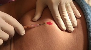 In this video Matt Kelleher, MD is performing and describing his "Cellulite Release and Lift" procedure. He frequently combines this with liposculpture for an incredibly efficient, effective, and inexpensive permanent solution to cellulite. Performing a subcision takes only a few seconds and the area is already numb from the lipo. The filler (the patient's own fat) is in ample and free supply from the concomitant lipo. This is a unique and revolutionary approach to the permanent correction of ce