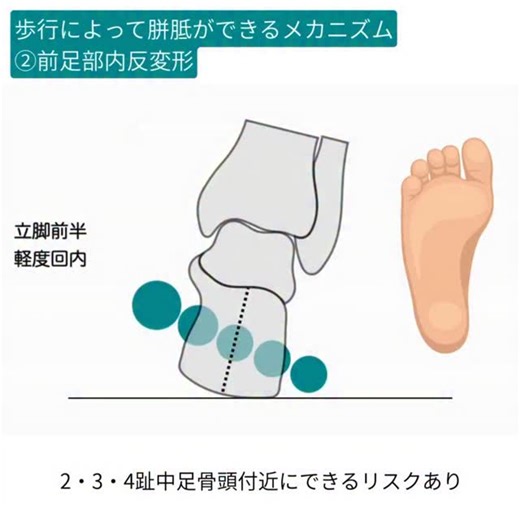 足のバイメカ×コンテンツクリエイター on Instagram: "歩行によって胼胝ができるメカニズム ②前足部内反"