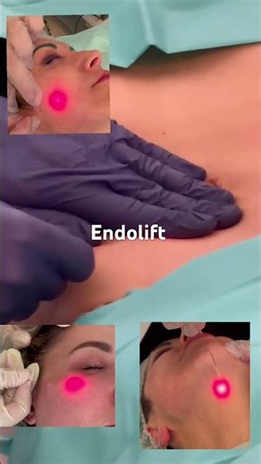 Endolif Bauch Hängewangen Doppelkinn Augenschwellung ￼