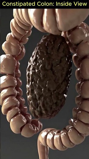 Inside the Colon: Ultra Slow-Motion 3D Animation of Constipated Stool Blockage | 11