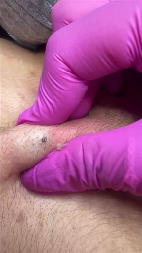 Cyst Popping Compilation: Most Satisfying Skin Cleansing #asmr #satisfying 😱✨