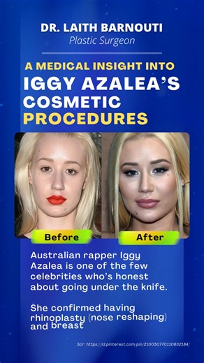 ✨ A Medical Insight into Iggy Azalea's Cosmetic Procedures ✨ Australian rapper Iggy Azalea is one of the few celebrities who’s open about her transformation journey — proudly sharing that she’s had rhinoplasty and breast augmentation. Her procedures highlight how aesthetic surgery, when done with precision, can enhance balance and natural beauty rather than change identity. 💫 What do you think about her new look? Comments below! Book A consultation - Dr Laith Barnouti, Sydney Plastic Surgeons h