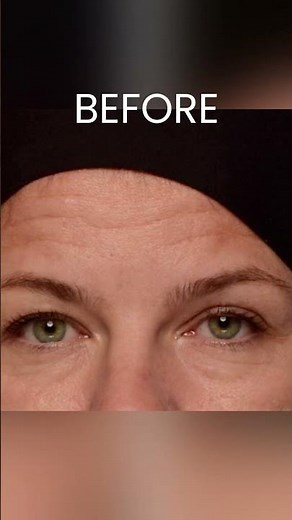 Before and After Botox Treatment (Neuromodulators) #cosmeticdermatology #botox