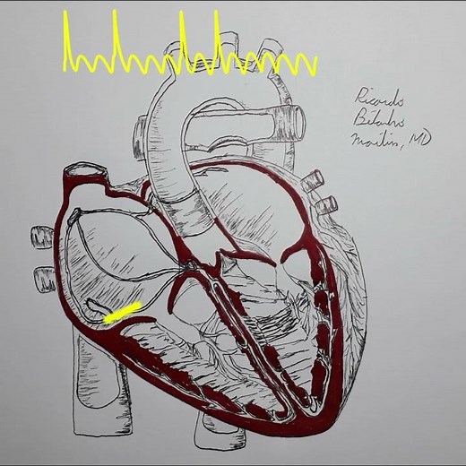 Flutter Auriculaire à Conduction Variable - Animation cardiaque et ECG