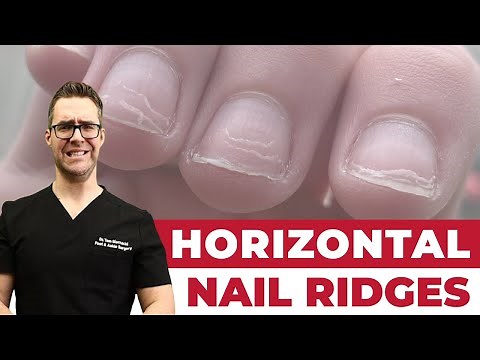 Horizontal Ridges on Nails? [What Does It Mean?]