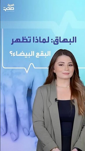 أطباء يوضحون أسباب وعلاج البهاق