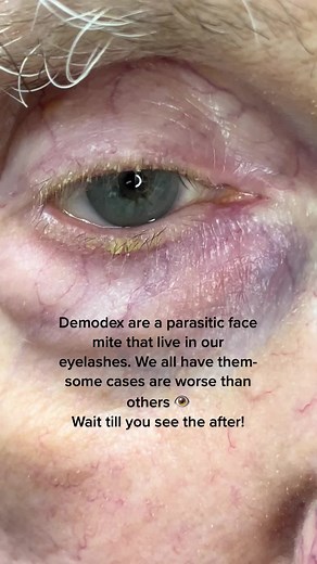 Before a BlephEx treatment #ScreamItOut #foryou ##ComeDanceWithMe #optometrist #demodex #eyes #ey #WomenOwnedBusiness #foryou #foryoupage #cleantok