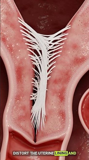The Silent Scar Tissue Inside the Uterus | 3D Medical View
