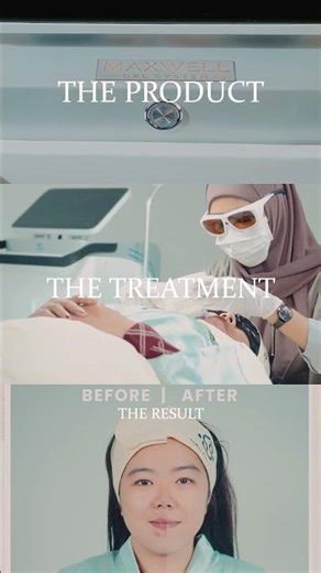 Treatment DPL Maxwell | Before After Perawatan Kulit