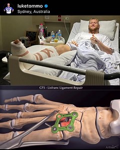 Luke Thompson has undergone surgery for his Lisfranc (midfoot) injury suffered at Bulldogs training. Usual recovery range of 3-4 months, overall a complex injury that is one of the more challenging to rehab. Wish him the best | NRL Physio