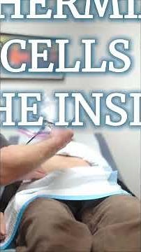 Shrinking Tumors Without Surgery or Radiation | Inside HMS Hyperthermia Therapy