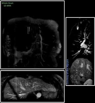 Whole Heart CE MRA - Gadovist @ Siemens 1.5T AvantoFit