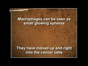 Cancer cells destroyed by GcMAF (video by First Immune)