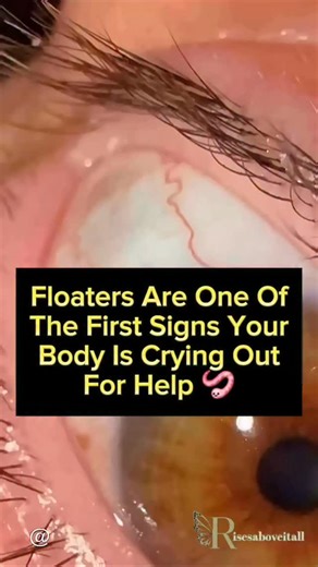 Rootcausemomma on Instagram: "Detox tip most people miss: If your elimination pathways are blocked, toxins don’t leave, they recirculate and create inflammation, hormone imbalance, fatigue, and stubborn weight gain. Before starting any detox, parasite cleanse, or heavy metal cleanse, make sure these pathways are open ⬇️ 💩 Daily bowel movements 💧 Proper hydration + minerals 😅 Sweating (exercise, sauna) 🫁 Deep breathing for oxygen + lymph flow 🤸‍♀️ Lymph movement (walking, rebounding, dry bru