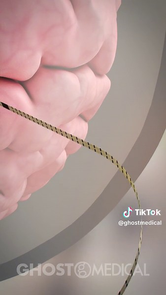 Learn about this remarkable Micro-Stereo-Electro-Encephalography (Micro-SEEG) system through a visually captivating animation produced by Ghost in collaboration with UC San Diego. The UCSD Micro-SEEG system, featuring a flexible electrode with a pocket design, is set to transform neurosurgical procedures. Its ultra-thin structure with 128 PtNR micro contacts and 16 PtNR macro contacts offers unprecedented capabilities for brain recording and stimulation. This state-of-the-art technology, develop