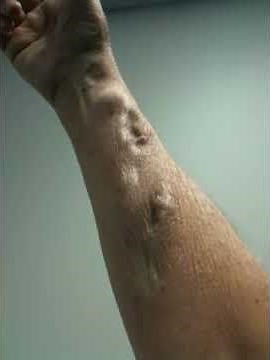 Dialysis fistula, up and down