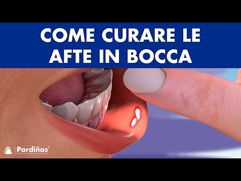AFTE IN BOCCA – Rimedi per le ULCERE orali ©