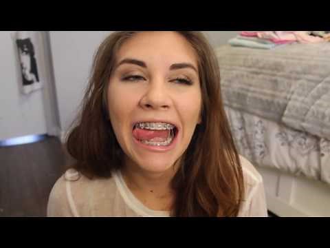 Braces & Rubberbands Video of Bracefacebeauty Victoria