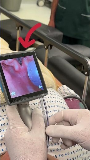 Struggling with Difficult Intubation? Try a Channeled VL! #hospital #airwaymanagement #laryngoscope