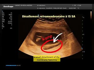 🚨Pertes de sang et petites contractions😟 à 15 SA de grossesse , mon diagnostic 🤔
