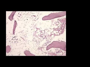 Dr. Naglaa Salem, MD, FCAP- Interpretation of BM Biopsies