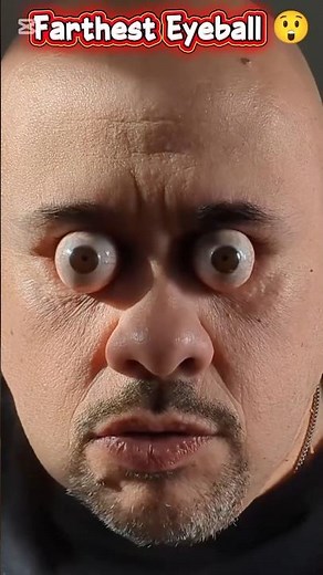 Farthest Eyeball Pop Ever Seen 😲 | Medical Health TV Official