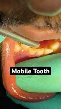 Mobile Tooth and Treatment