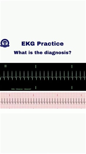 Medicine Master Academy | USMLE on Instagram: "You are welcome to participate 😉 #usmle #doctorslife #nurse #medschool #medicalstudent #medicalquiz #clinicalcase #doctor #usmlestep1 #usmlestep2 #medicinemasteracademy #neet #mcat #ecg #ekg #electrocardiogram #meded #Cardiology ECG provided by @dialedmedics"