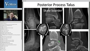 Talar Fractures: Anatomy, Imaging and Classification