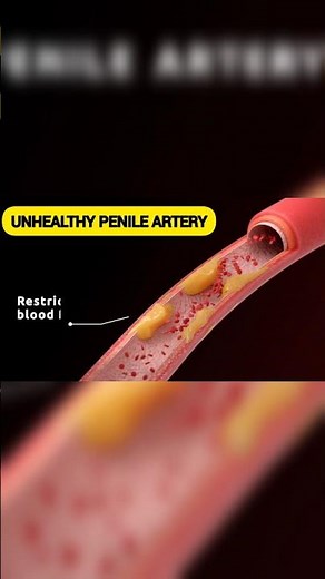 Penile Angioplasty: The Best Treatment for Erectile Dysfunction