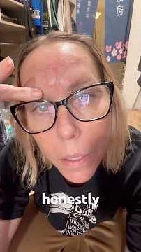 Skin Surgery Update: one week post stitch removal | Melanoma Face Surgery |