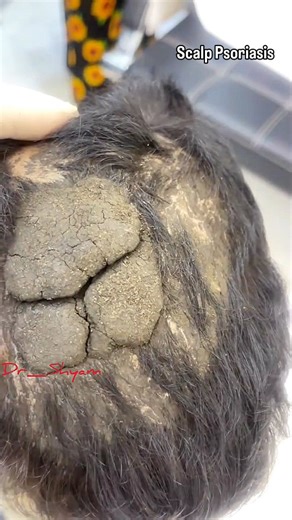 DR.SHYAM PANDIT on Instagram: "Severe Scalp psoriasis s a chronic autoimmune condition causing red, inflamed skin with thick silvery scales on the scalp leading to intense itching, soreness and potential temporary hair loss often mistaken for dandruff but more severe, managed with medicated shampoos, topical steroids tar treatments and other therapies to control flare It's caused by the immune system overspeeding skin cell production, creating cell buildup and while not curable treatments help c