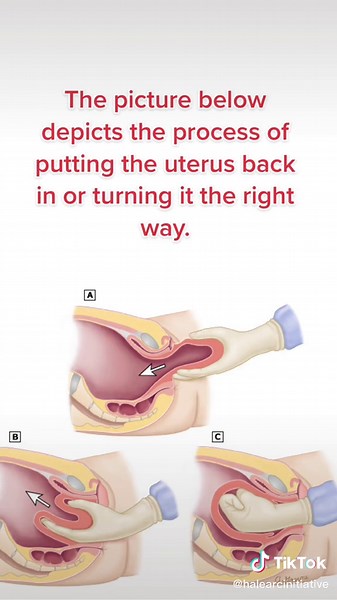 Understanding Uterine Inversion: Causes, Symptoms, and Treatment