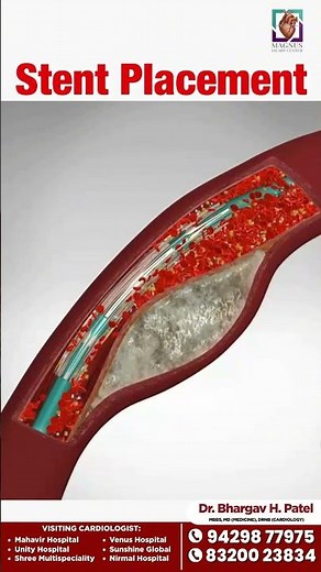 How Angioplasty Works | Stent Placement Explained with Animation | Dr. Bhargav Patel