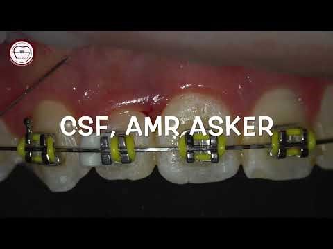 finishing orthodontics CSF circumferential-supracrestal fiberotomy after rotation- perio ortho