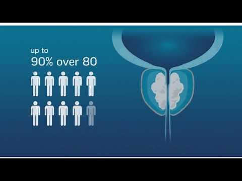 Rezūm Patient Educational Video