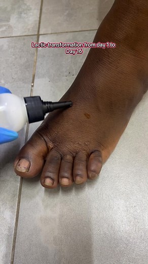 Lactic Transformation for Dark Legs: Day 1 to Day 16