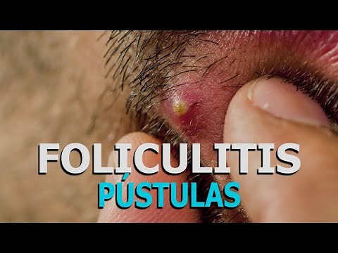 FOLICULITIS | Dermatología: Pústulas (barritos), folículo piloso inflamado | Dr. Arenas